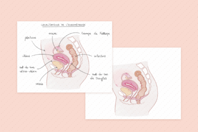 Illustration de la localisation de l’endométriose (vue de côté)
