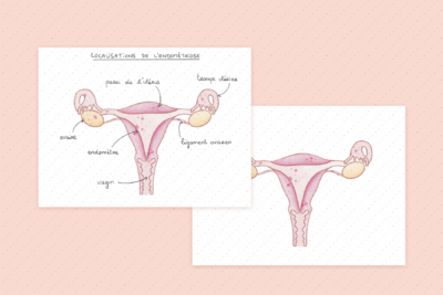 Illustration de la localisation de l’endométriose (vue utérus)