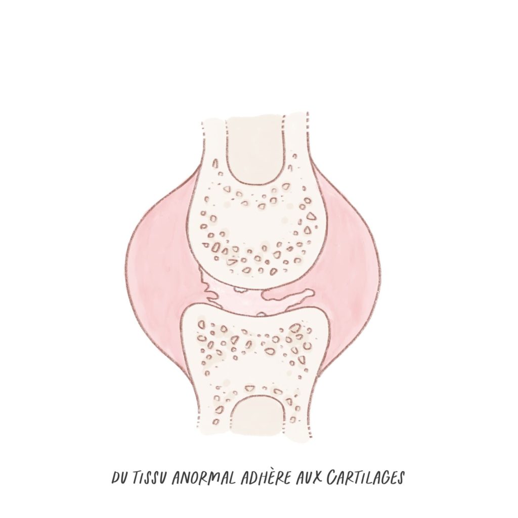 du tissu anormal adhère aux cartilages