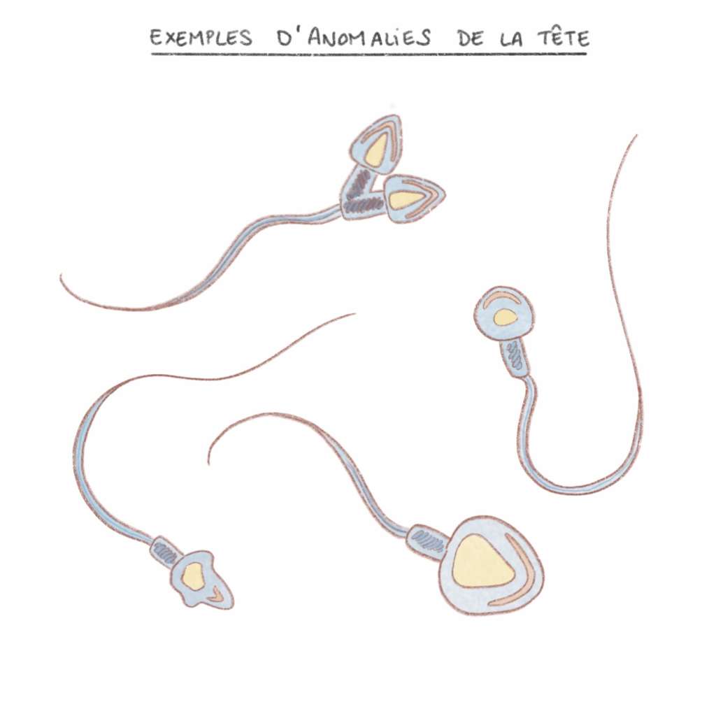 Cause d'infertilité masculine : les anomalies de la tête des spermatozoïdes